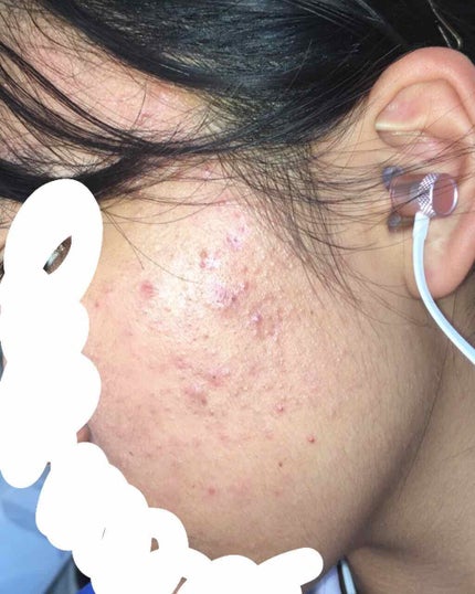 薬用ニキビケア スポッツクリーム/アクネスラボ/フェイスクリームを使ったクチコミ(1枚目)