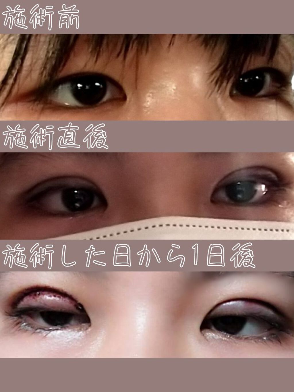 のびーるアイテープ（絆創膏タイプ、レギュラー）/DAISO/二重まぶた用アイテムを使ったクチコミ（2枚目）