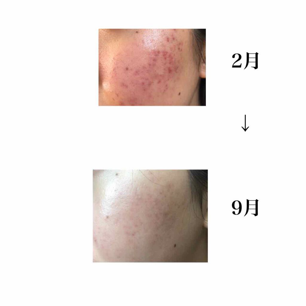 N10+Z1フェイスセラム /The Ordinary/美容液を使ったクチコミ（3枚目）