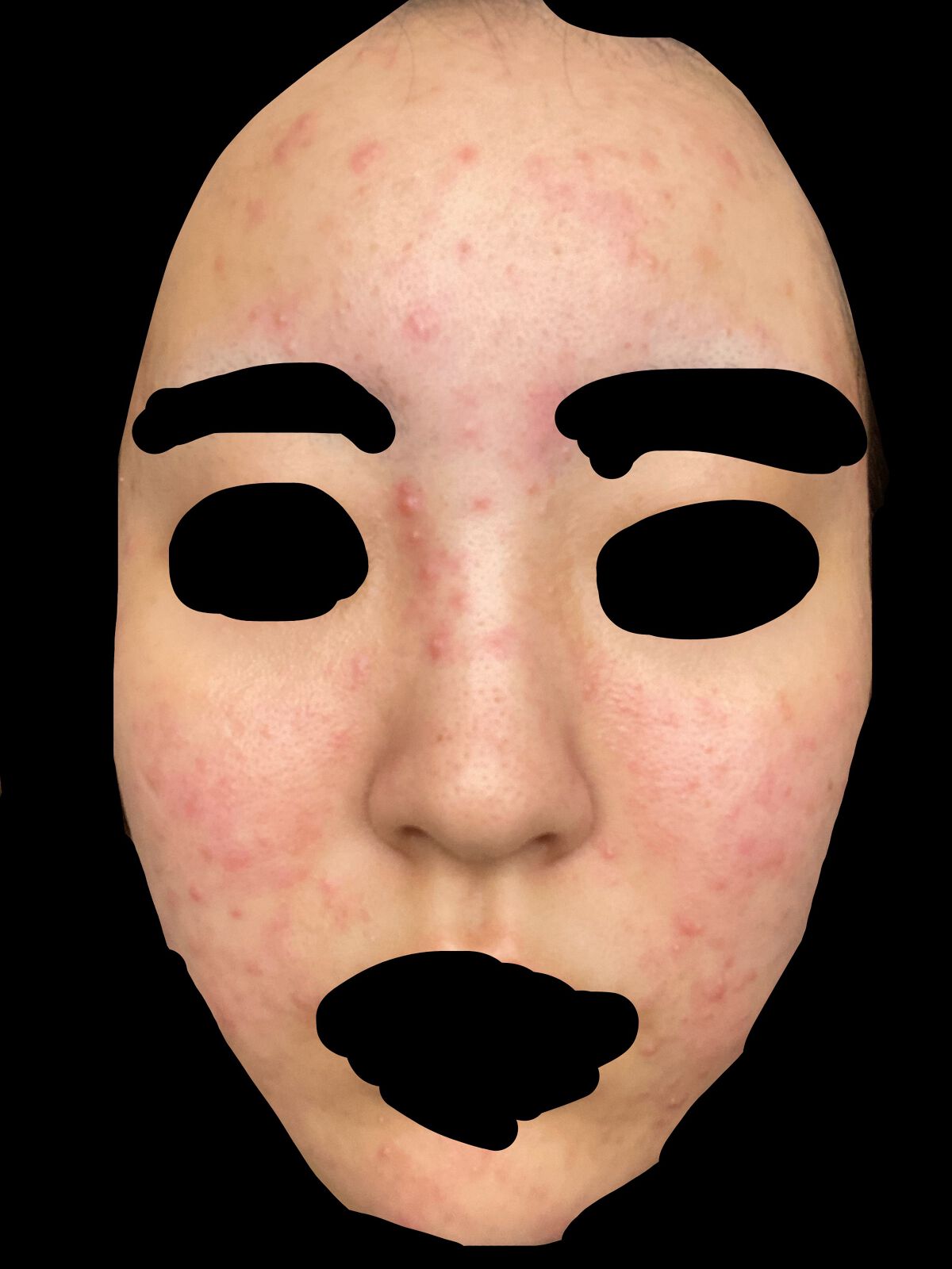 オードムーゲ 薬用ローション(ふきとり化粧水)/オードムーゲ/拭き取り化粧水を使ったクチコミ(2枚目)