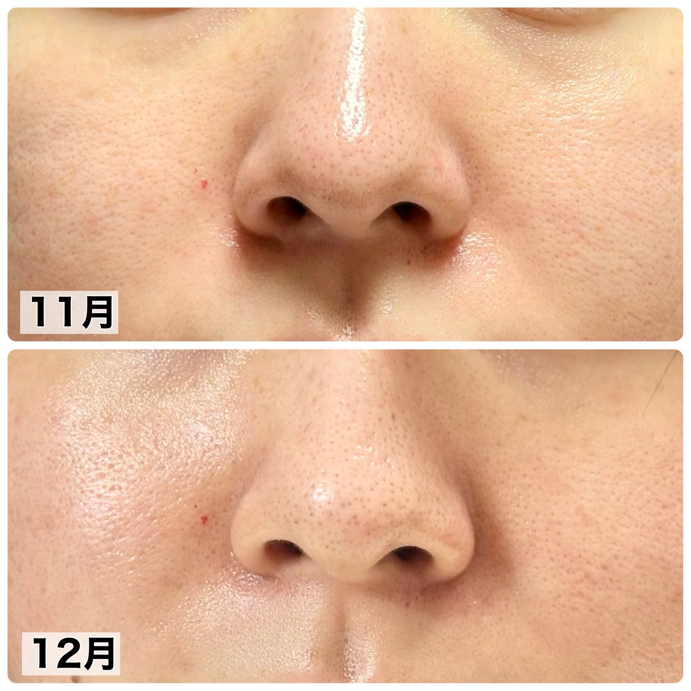 タカミスキンピール/タカミ/ブースター・導入液を使ったクチコミ(2枚目)