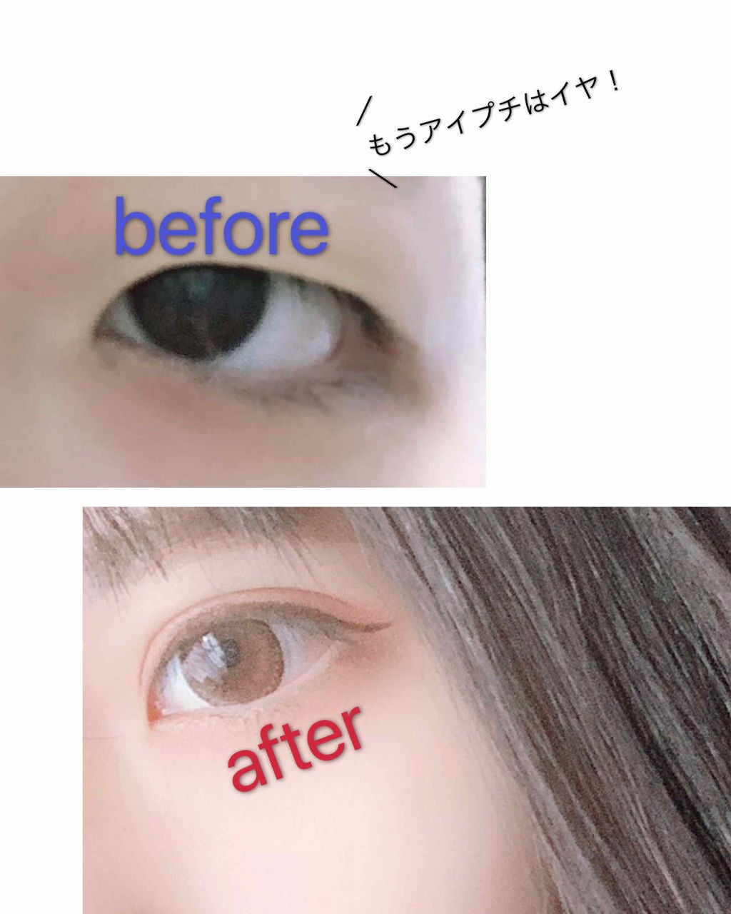 さほ on LIPS 「注意!!目のアップの画像、2枚目に整形直後(切開)の腫れた目の..」(1枚目)