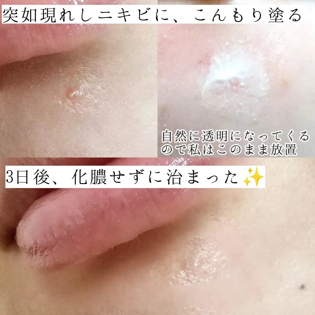 アクネキュアクリーム(医薬品)/IHADA/その他を使ったクチコミ(3枚目)