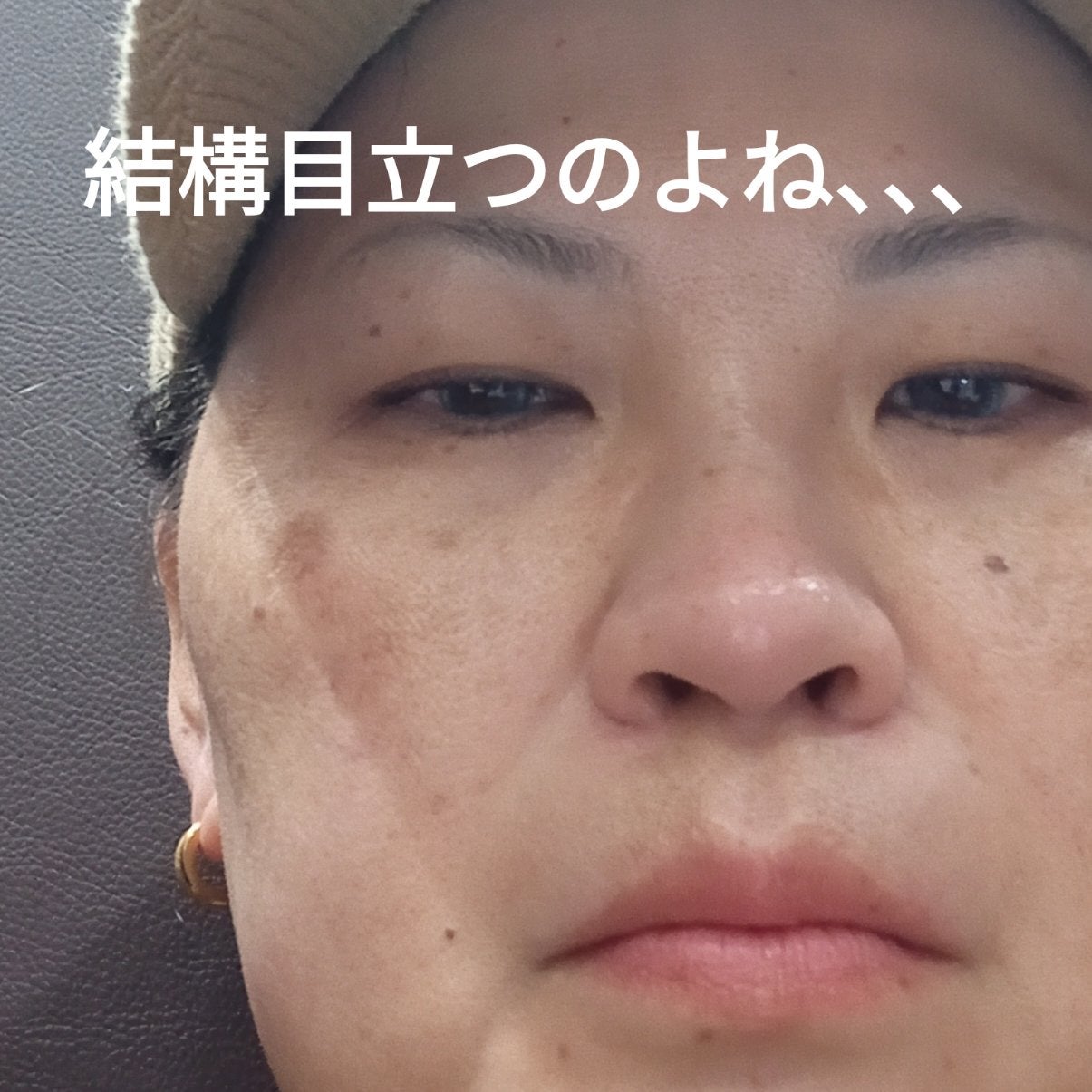 ビヨンセ奥二重向上委員長🥸LIPSパートナー🥳 on LIPS 「湘南美容クリニックでシミ取りレーザーしてきたよ!なんと3つで7..」(4枚目)