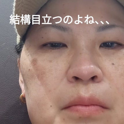 ビヨンセ奥二重向上委員長🥸LIPSパートナー🥳 on LIPS 「湘南美容クリニックでシミ取りレーザーしてきたよ!なんと3つで7..」(4枚目)