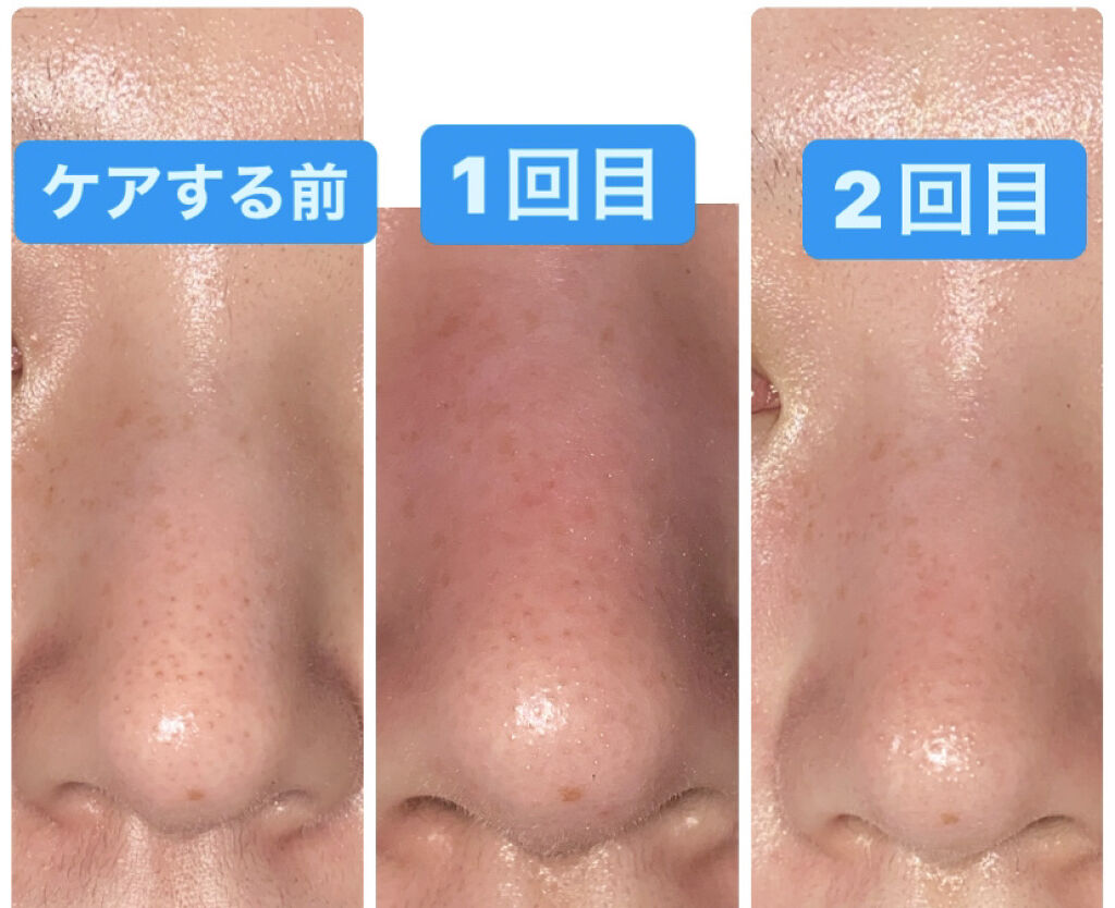 アンチポアブラックヘッドパーフェクトクリアキット/CNP Laboratory/シートマスク・パックを使ったクチコミ（2枚目）