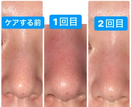 アンチポアブラックヘッドパーフェクトクリアキット/CNP Laboratory/シートマスク・パックを使ったクチコミ(2枚目)