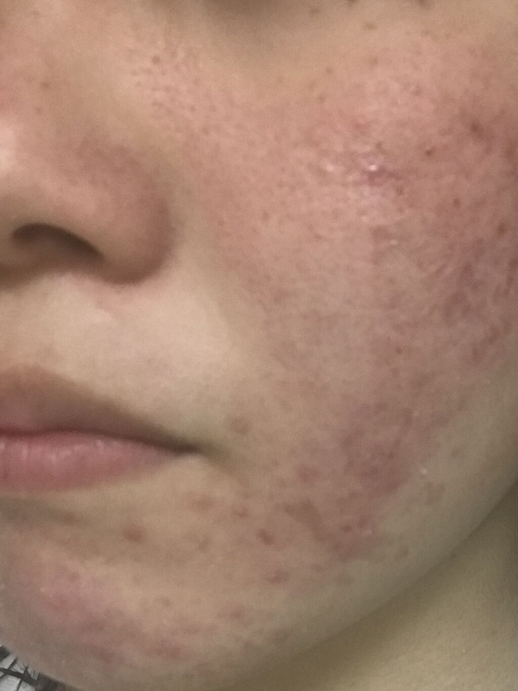 エピデュオゲル/マルホ株式会社/その他を使ったクチコミ（2枚目）