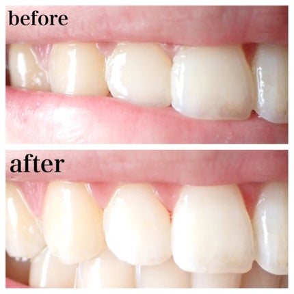 THE 歯の黄ばみ集中パック/武内製薬 THEシリーズ/その他オーラルケアを使ったクチコミ(5枚目)