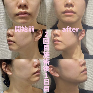 Tomomi on LIPS 「はじめての美容医療〜脂肪溶解リニアHIFU〜2回目施術後1日目..」（3枚目）