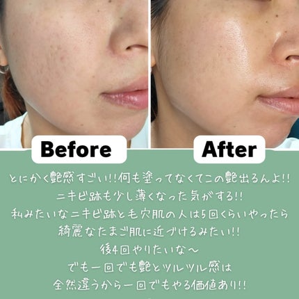 ダーマスキンピーリング/BQCELL/その他キットセットを使ったクチコミ(5枚目)