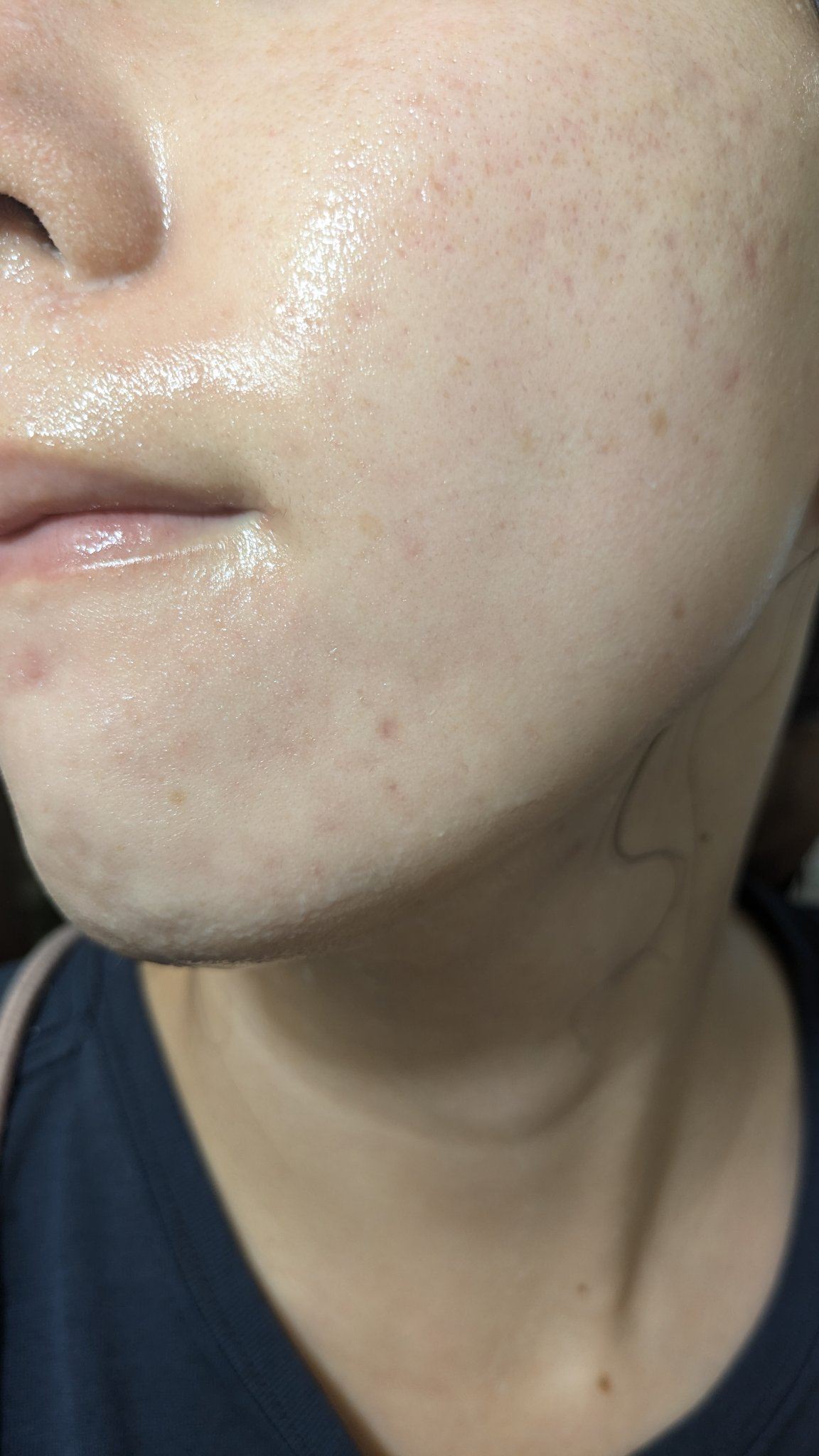 A2+NAG2ソリューション/The Ordinary/美容液を使ったクチコミ（2枚目）