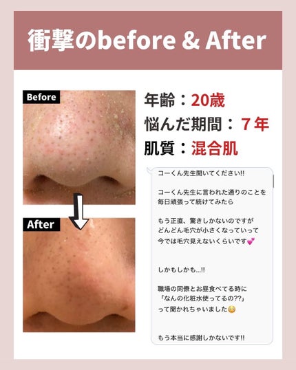 あなたの肌に合ったスキンケア💐コーくん先生 on LIPS 「【知らないと損】鼻の角栓3日で消す裏技🤫..あなたの毛穴の開き..」(4枚目)