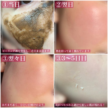 ダーマスキンピーリング/BQCELL/その他キットセットを使ったクチコミ(3枚目)