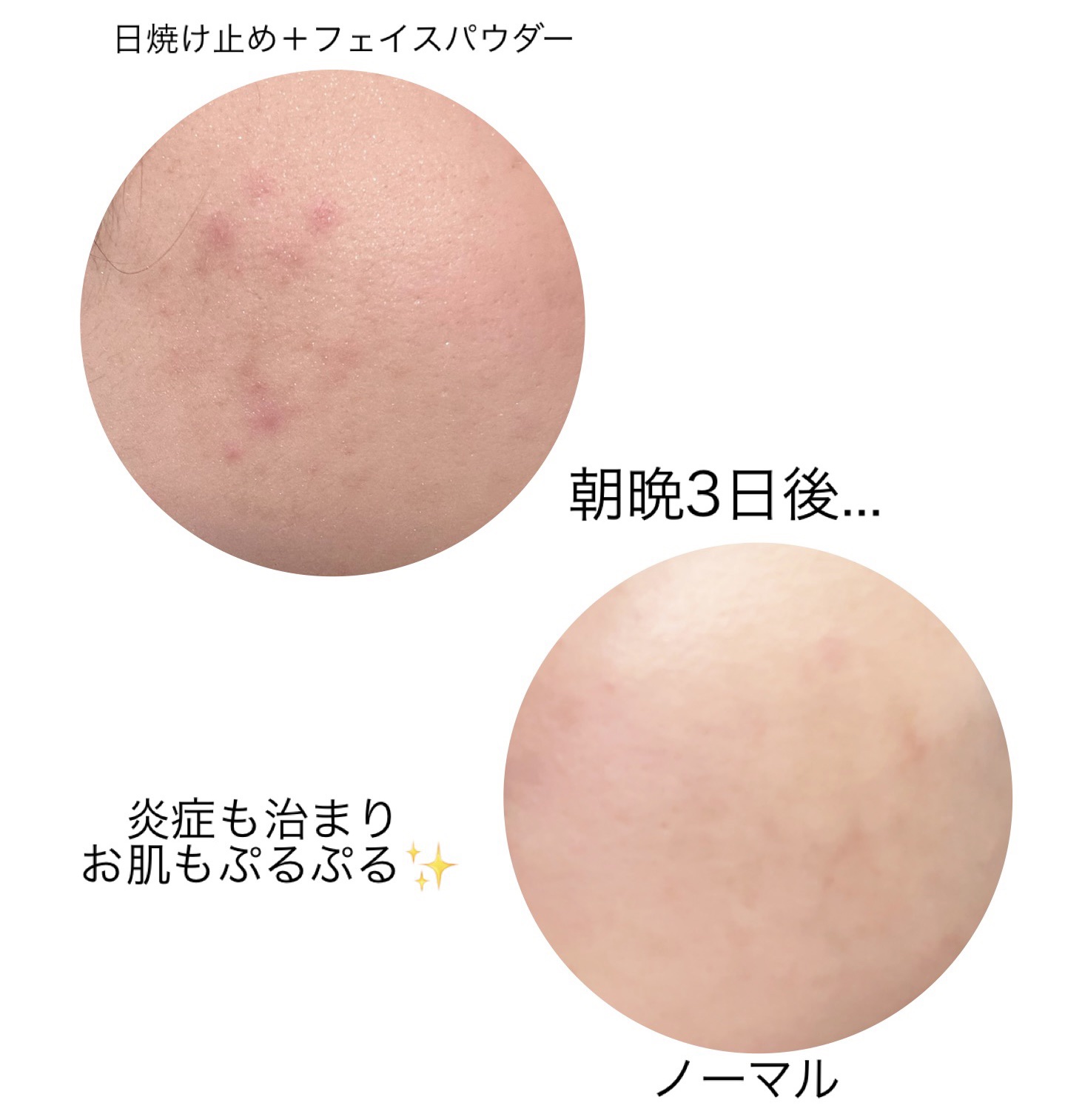 薬用クリアスキンケアセット/IHADA/スキンケアキットを使ったクチコミ（2枚目）