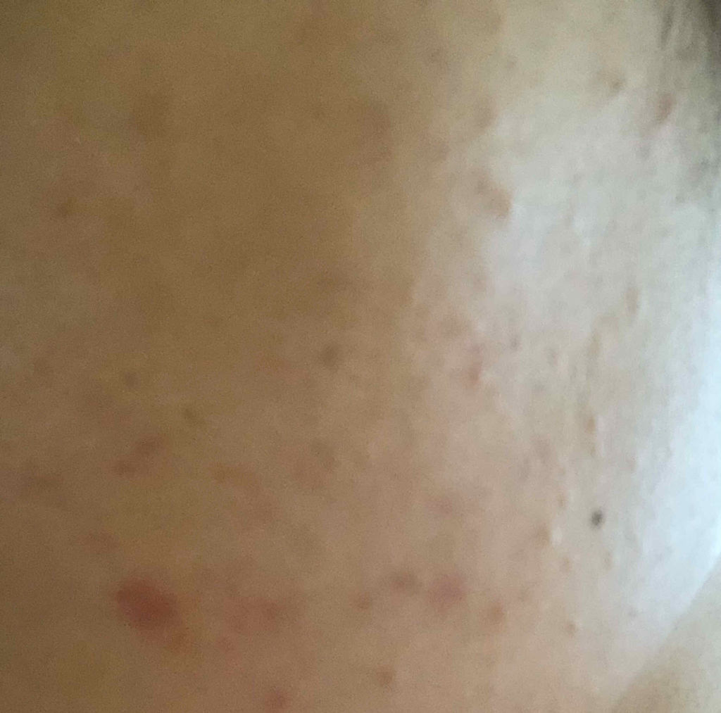 ミノン アミノモイスト 薬用アクネケア ローション/ミノン/化粧水を使ったクチコミ（2枚目）