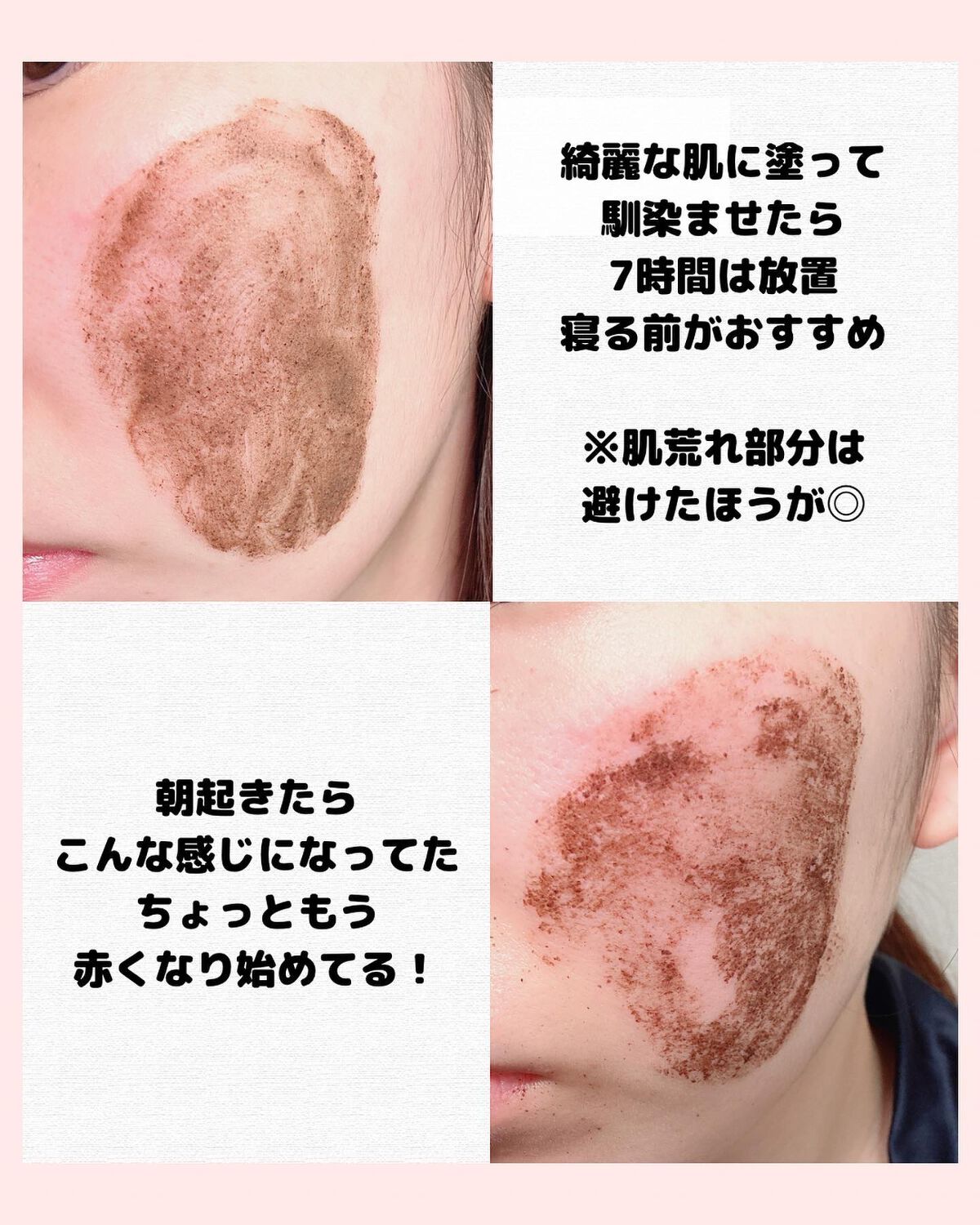 ダーマスキンピーリング/BQCELL/その他キットセットを使ったクチコミ(5枚目)