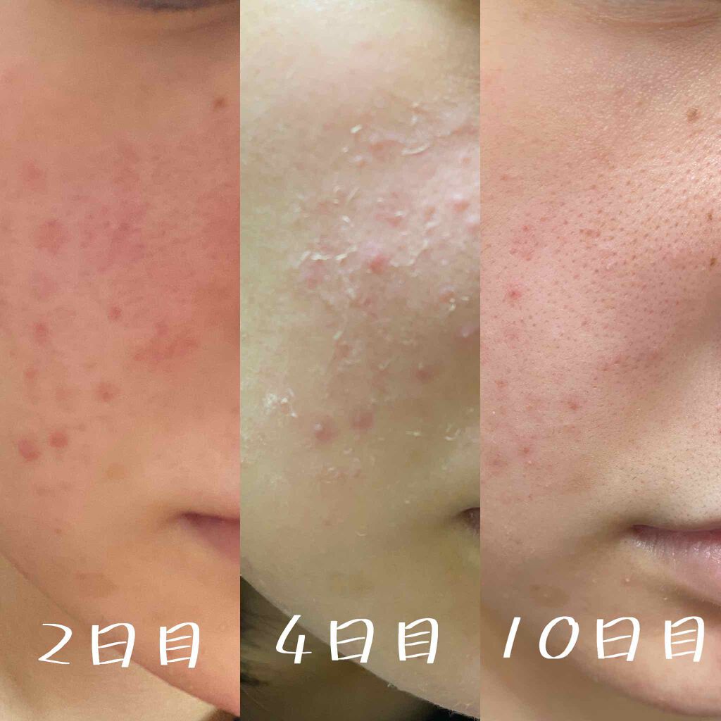 チベット on LIPS 「これは超絶敏感肌の高校生のつい最近体験談です!みんながそうとは..」(2枚目)