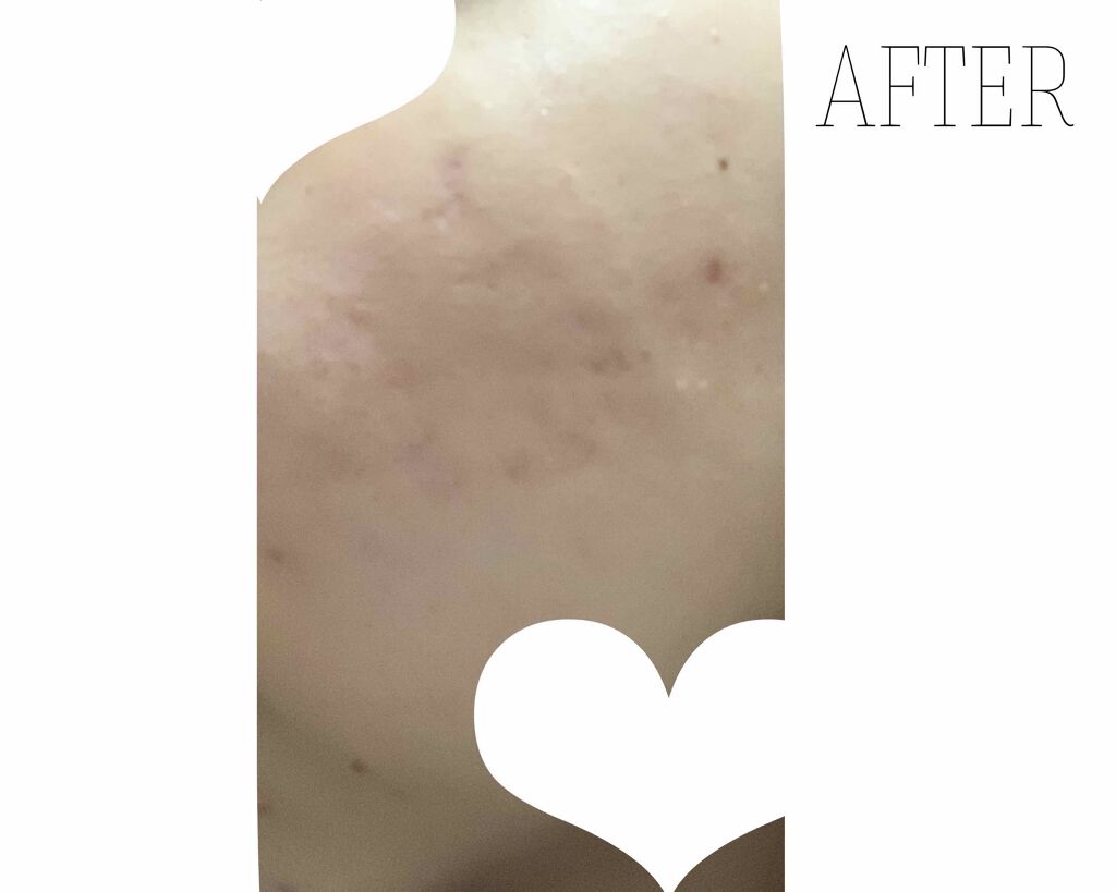 Cちゃん on LIPS 「ダーマペン 4ヶ月半 経過お久しぶりです✌️地道にダーマペンを..」(3枚目)