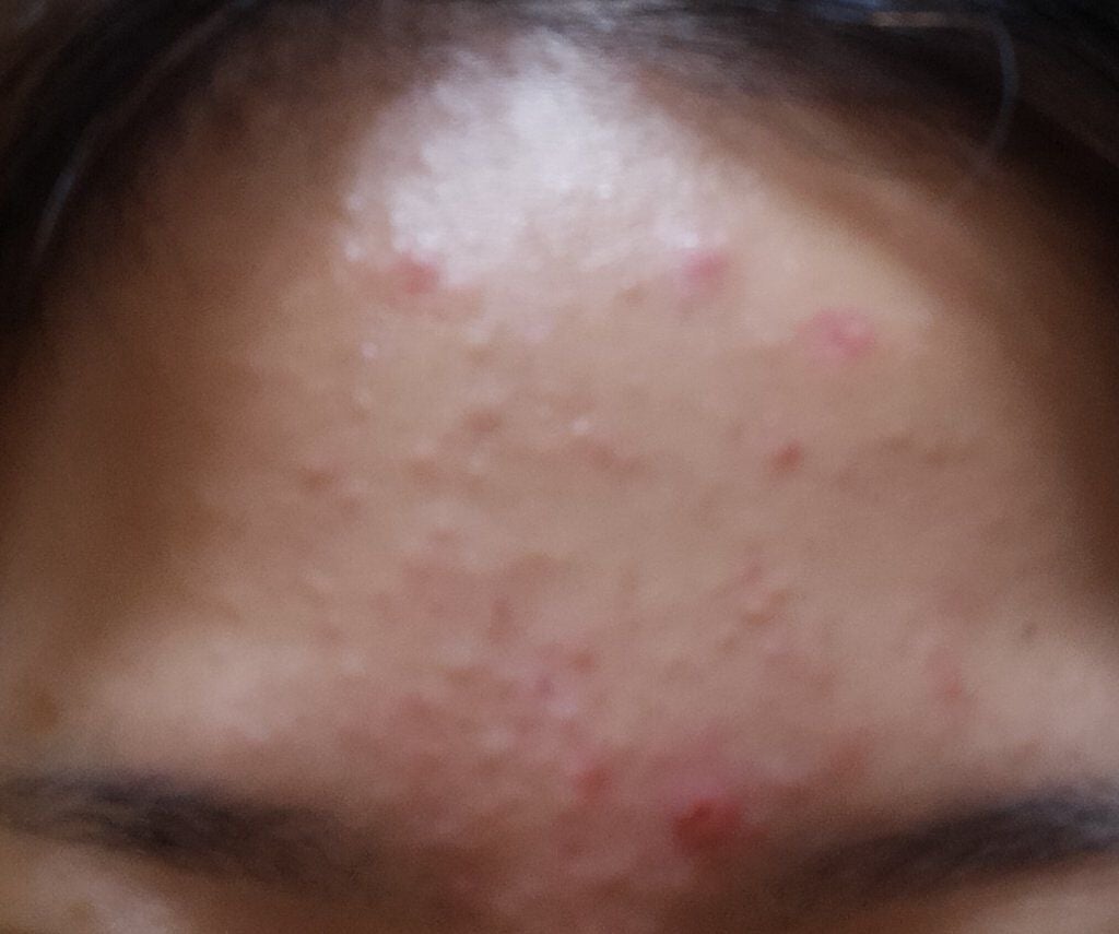 ペアアクネクリームW(医薬品)/ペア/その他を使ったクチコミ(2枚目)