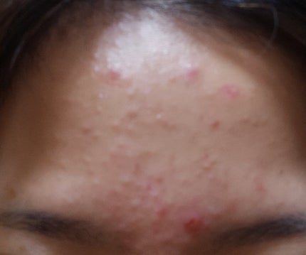 ペアアクネクリームW(医薬品)/ペア/その他を使ったクチコミ(2枚目)