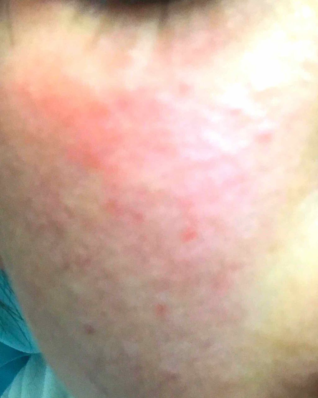 さいきc 治療クリーム（医薬品）/Saiki/その他を使ったクチコミ（3枚目）