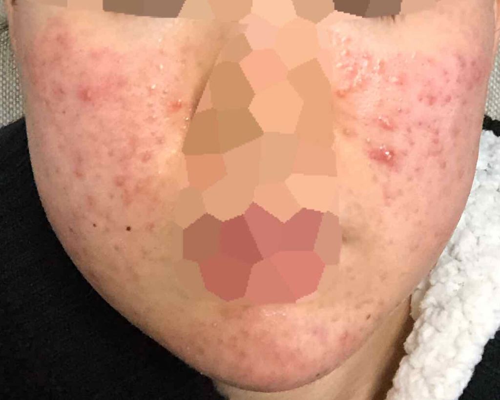 薬用3ステップセット30日サイズ/プロアクティブ/トライアルキットを使ったクチコミ（2枚目）