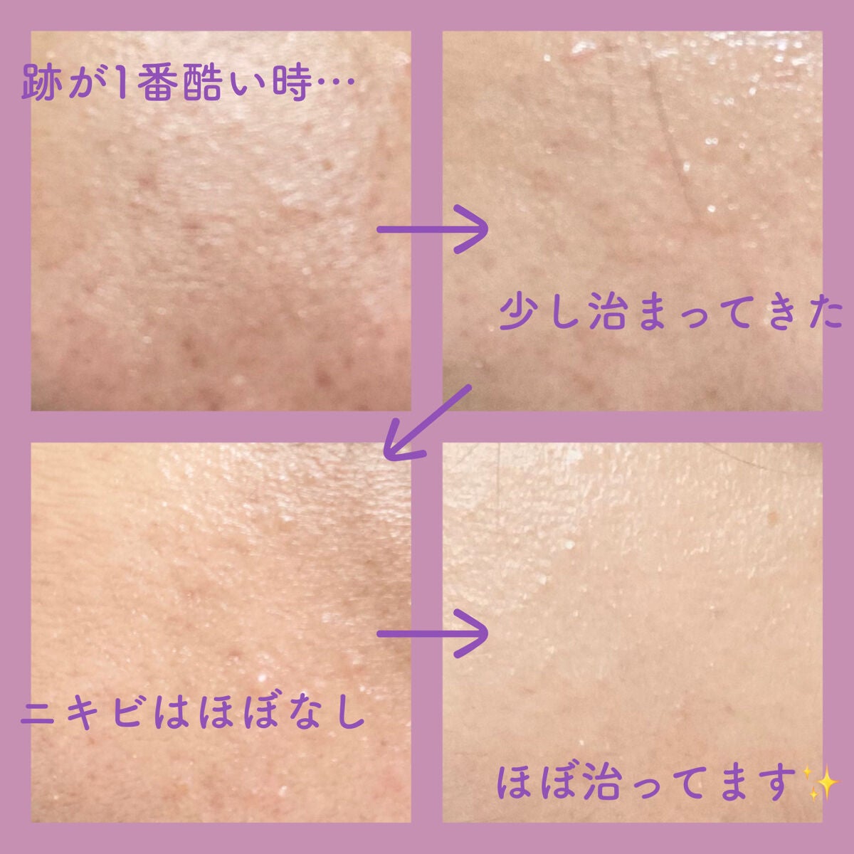 薬用しみ対策 美白化粧水 しっとりタイプ/メラノCC/化粧水を使ったクチコミ(4枚目)