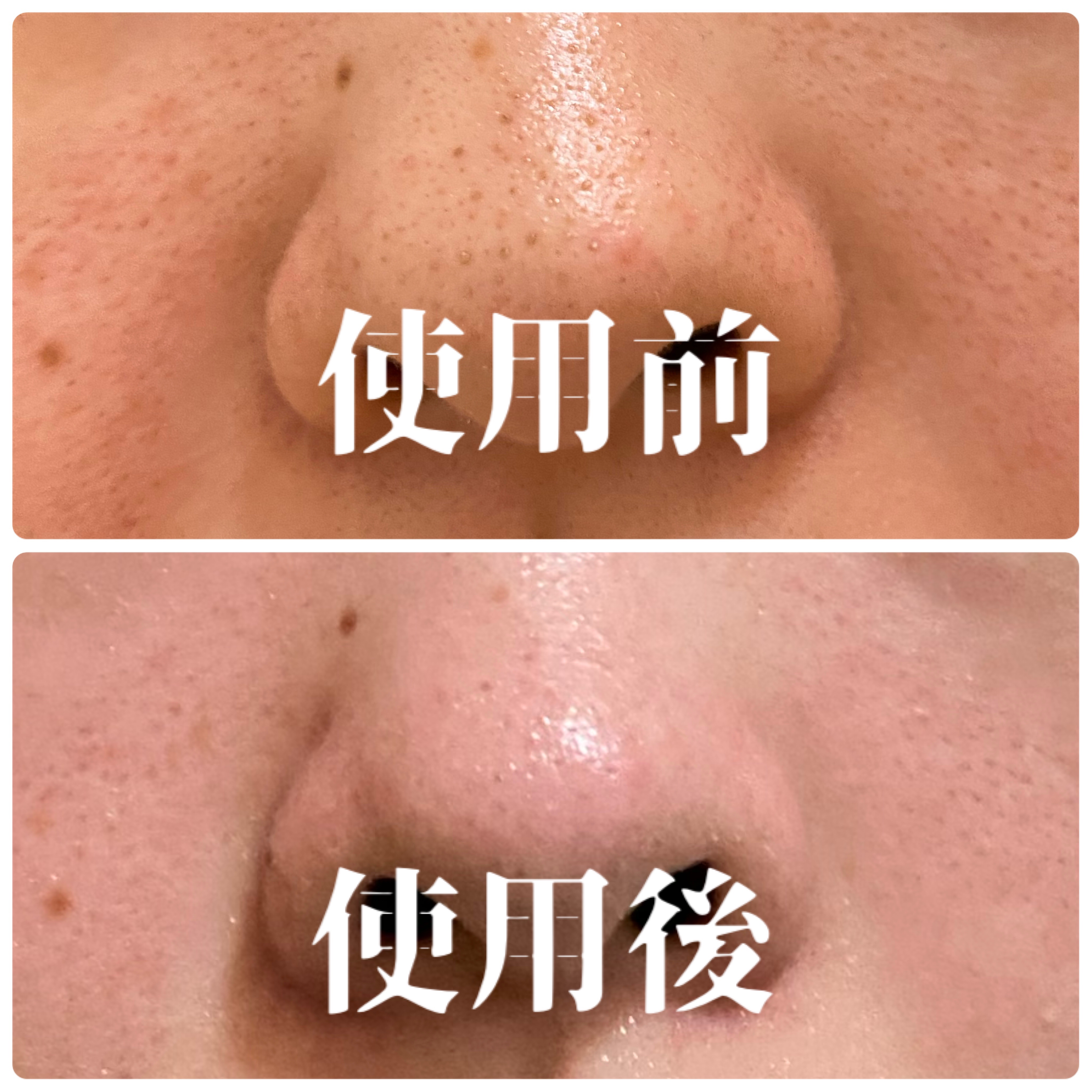 毛穴モップ (3STEP NOSE PACK)/YAMMY’S TOY/洗い流すパック・マスクを使ったクチコミ（2枚目）