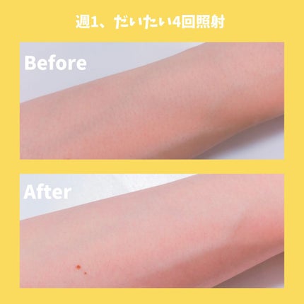 光美容器 光エステ ボディ&フェイス用 ハイパワー ゴールドES-CWP97-N/Panasonic/家庭用脱毛器を使ったクチコミ(4枚目)