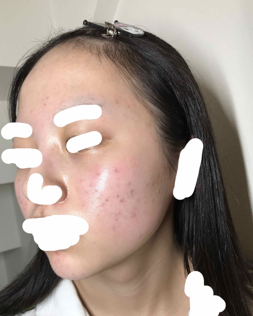 ベピオゲル/マルホ株式会社/その他を使ったクチコミ（1枚目）