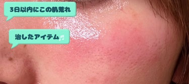 フルコートF（医薬品）/田辺三菱製薬/その他を使ったクチコミ（1枚目）