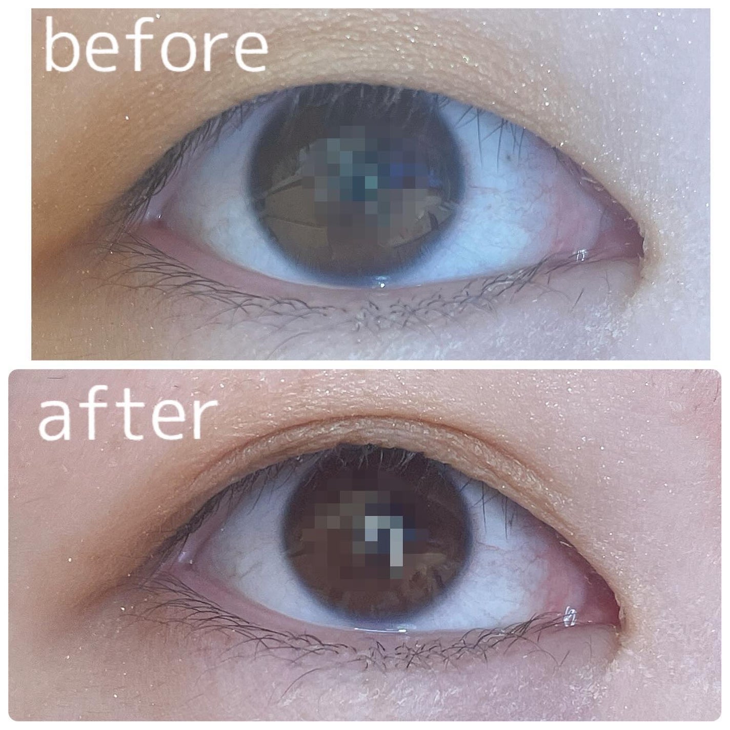 polser161cm on LIPS 「まぶたをグイッと折り込む!完全改良版のオリプチ+Rで簡単二重に..」(6枚目)