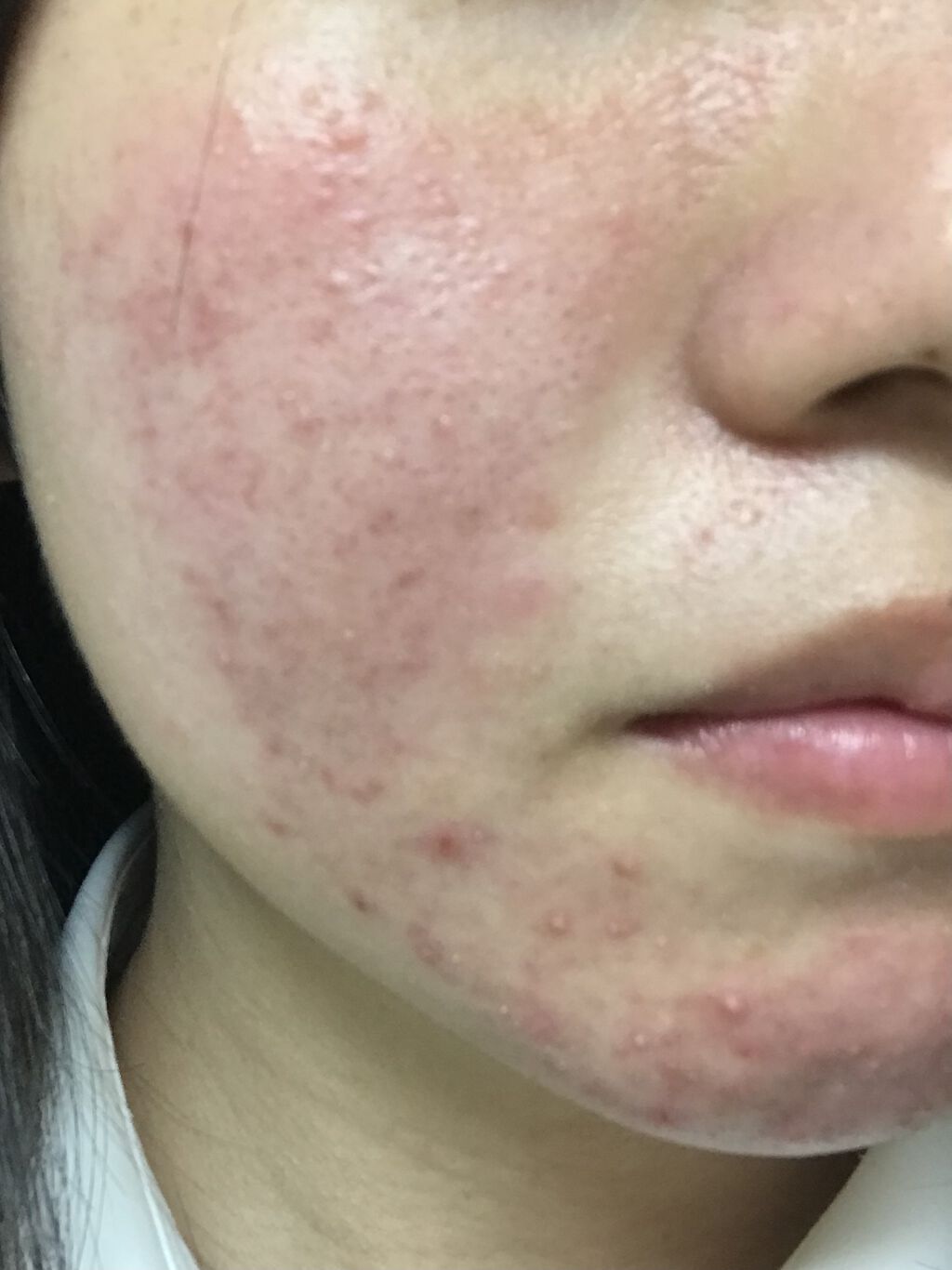 ベピオゲル/マルホ株式会社/その他を使ったクチコミ（1枚目）