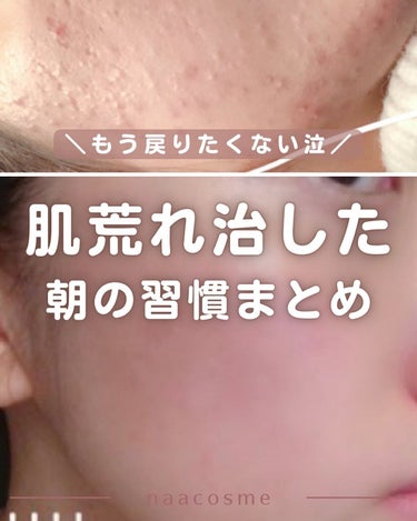 なーこ🫧ニキビ・肌荒れを美肌に on LIPS 「@naaacosme→肌荒れ地獄から、ファンデ断ちができるまで..」（1枚目）