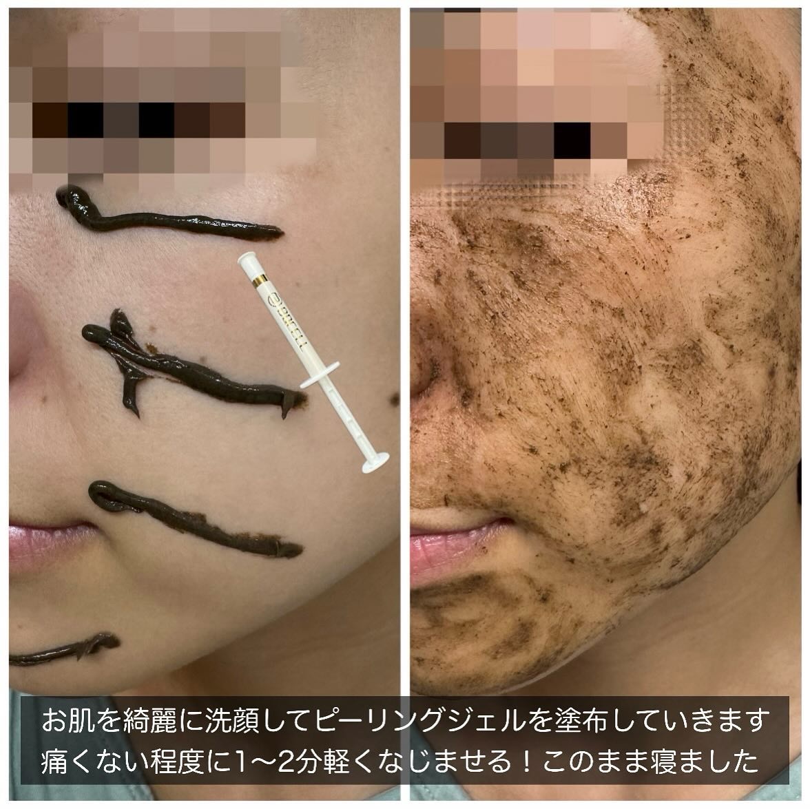 ダーマスキンピーリング/BQCELL/その他キットセットを使ったクチコミ（2枚目）