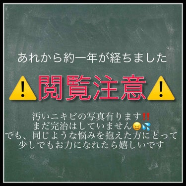 皆さまお久しぶりです。
もう私のことなんてきっと記憶から薄れているとは思いますが、ふと1年前の写真を見直してみたら格段に肌が綺麗になっていることに気付いたので記録を残させて頂きます。
実は、前回のニキビ