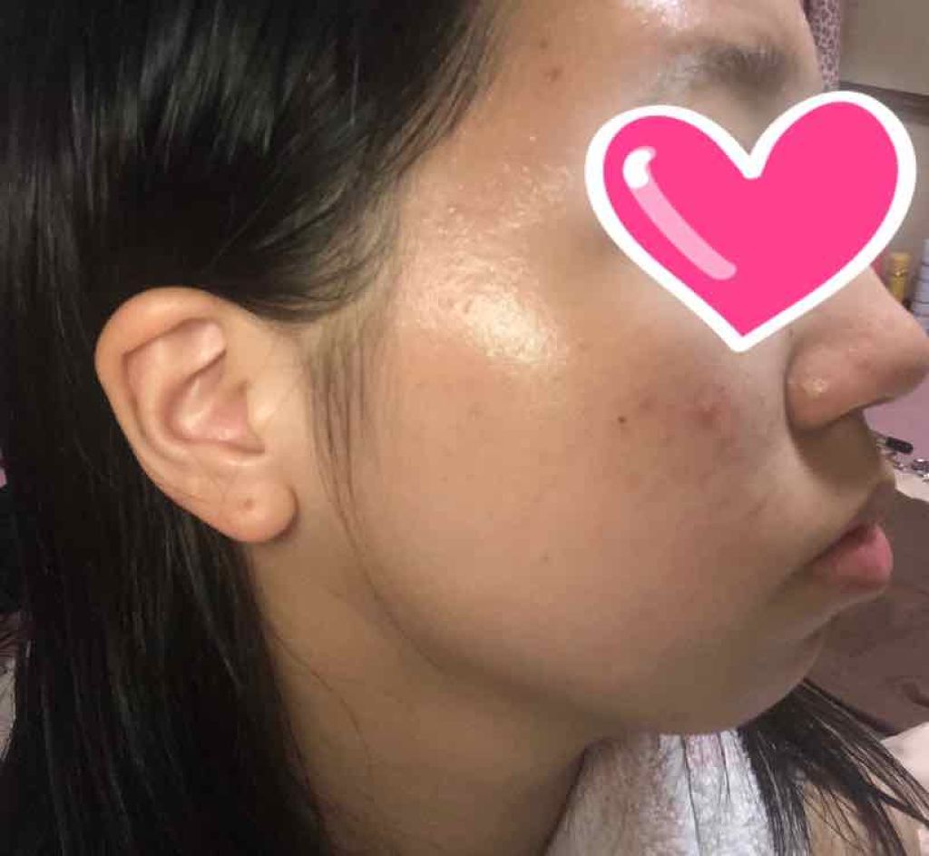HH on LIPS 「前に比べて少しニキビ跡が減ってる気がする!前回の写真は前の投稿..」(2枚目)