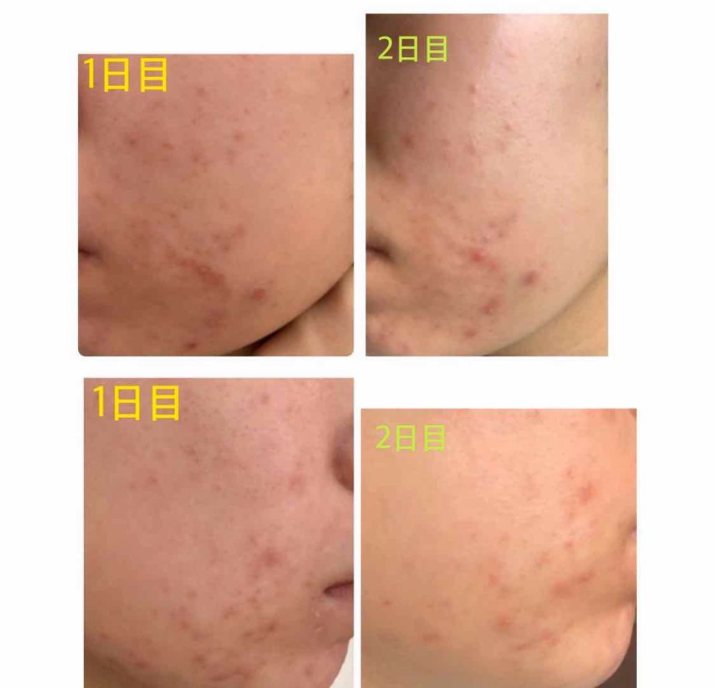 エピデュオゲル/マルホ株式会社/その他を使ったクチコミ（2枚目）