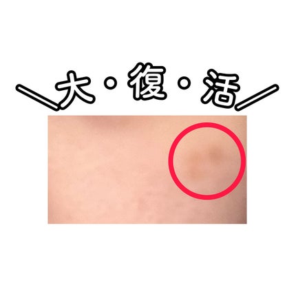 おんたま(フォロバ100) on LIPS 「2年前にシミ取りをしたので経過を載せます📸✂ーーーーーーーーー..」(4枚目)