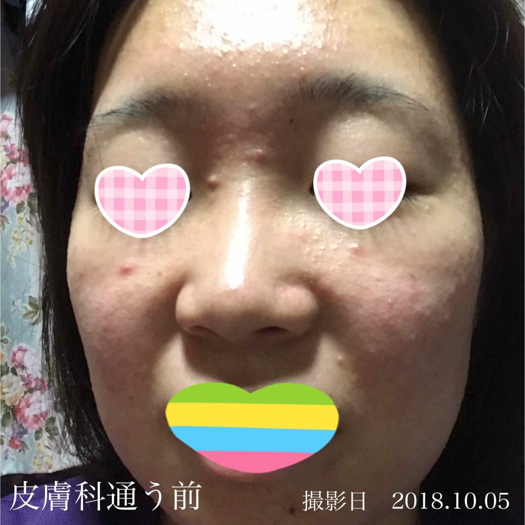 薬用パウダー化粧水/メンソレータム アクネス/化粧水を使ったクチコミ(3枚目)