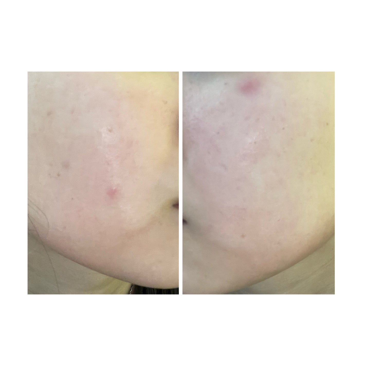 ぽむ on LIPS 「2023.9.13皮膚科に受診 エピデュオとヘパリン処方1枚目..」(4枚目)