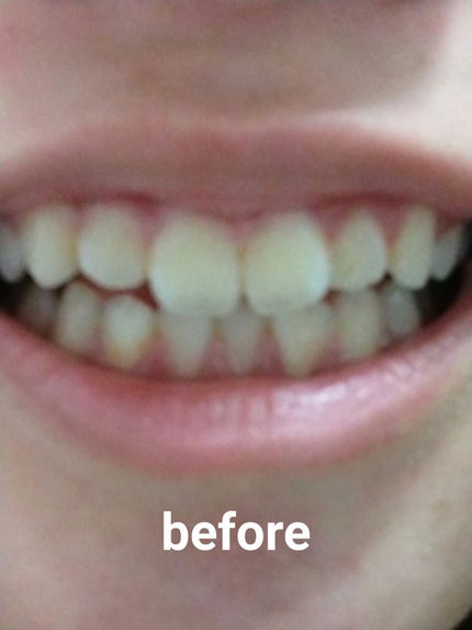 オクチホワイトニング(液体ハミガキ)/オクチシリーズ/歯磨き粉を使ったクチコミ(5枚目)