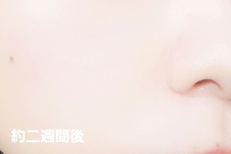 エファクラ ピールケア セラム/ラ ロッシュ ポゼ/美容液を使ったクチコミ（3枚目）