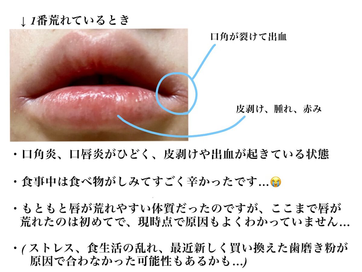 メディカルリップb(医薬品)/メンソレータム/その他を使ったクチコミ（2枚目）