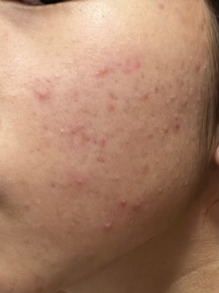 ゆゆ on LIPS 「ニキビ、沢山増えてしまいました泣一昨日皮膚科にやっと行き始めま..」(3枚目)