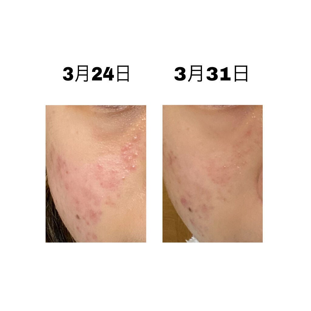 DHC ビタミンCハードカプセル/DHC/美容サプリメントを使ったクチコミ(2枚目)