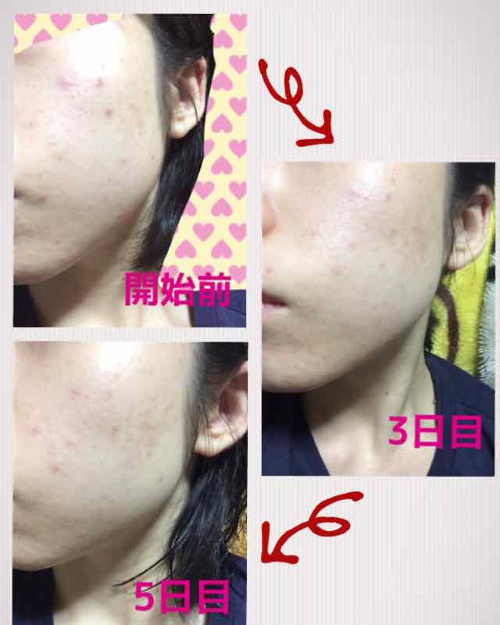 薬用 しみ 集中対策 美容液/メラノCC/美容液を使ったクチコミ（3枚目）