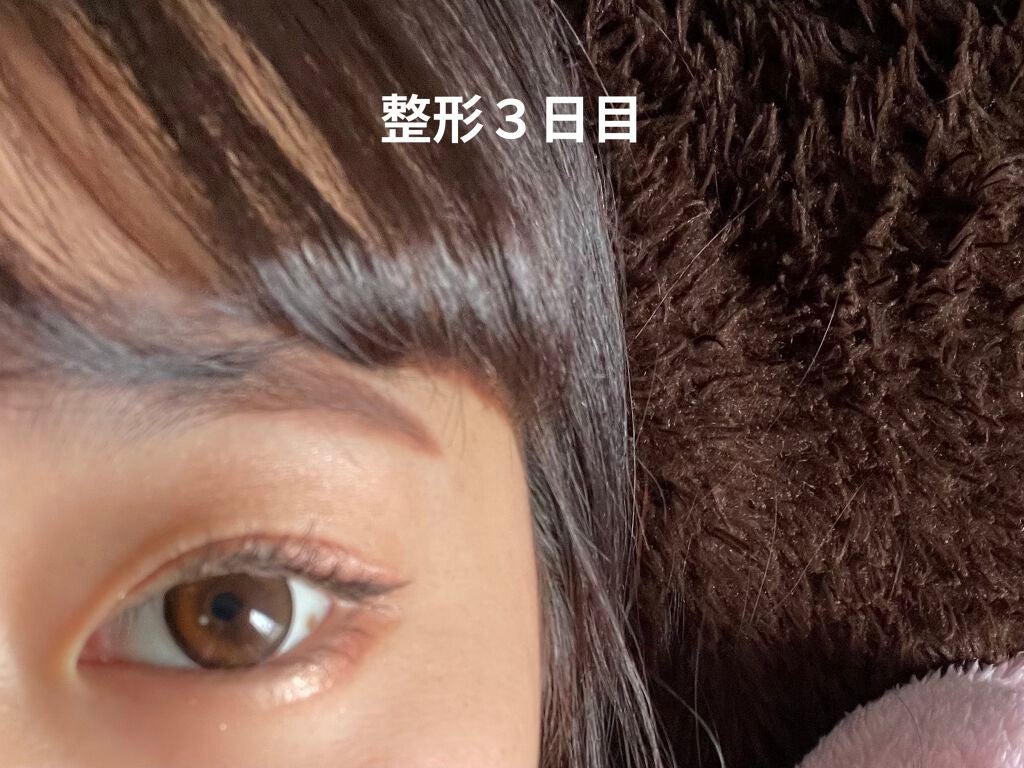 なつ on LIPS 「二重整形(埋没)しました整形記録1閲覧注意2日目〜 右目眼球内..」(7枚目)