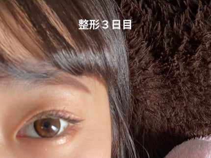 なつ on LIPS 「二重整形(埋没)しました整形記録1閲覧注意2日目〜 右目眼球内..」(7枚目)